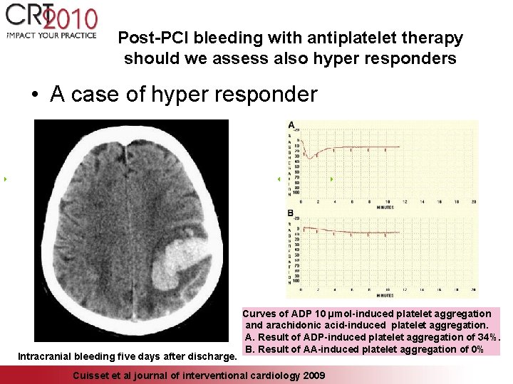 Post-PCI bleeding with antiplatelet therapy should we assess also hyper responders • A case