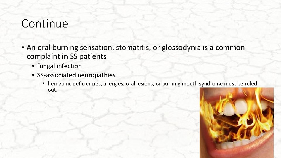 Continue • An oral burning sensation, stomatitis, or glossodynia is a common complaint in