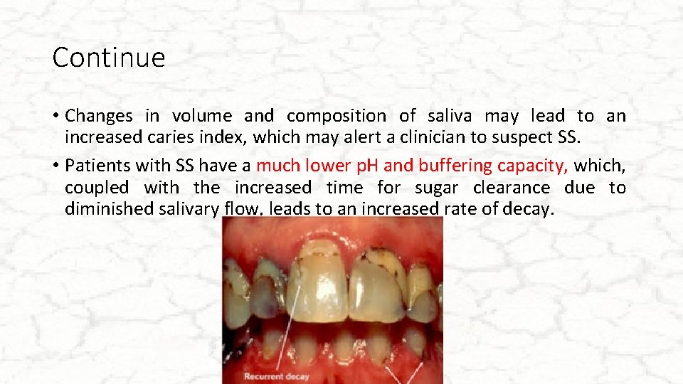 Continue • Changes in volume and composition of saliva may lead to an increased