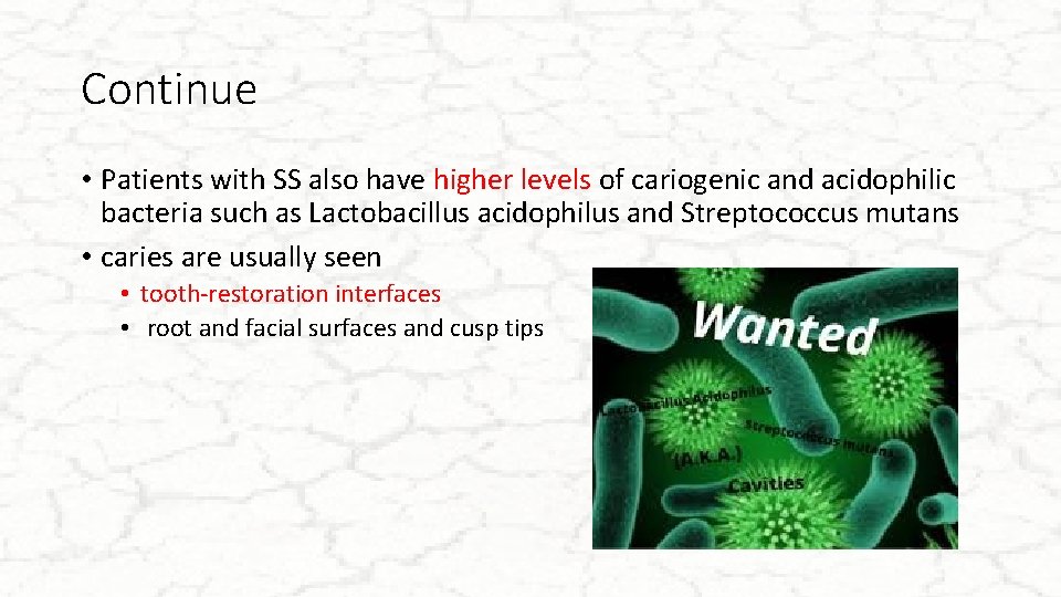 Continue • Patients with SS also have higher levels of cariogenic and acidophilic bacteria