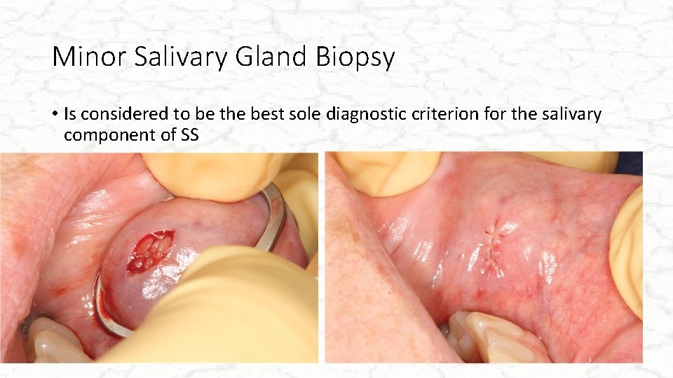 Minor Salivary Gland Biopsy • Is considered to be the best sole diagnostic criterion