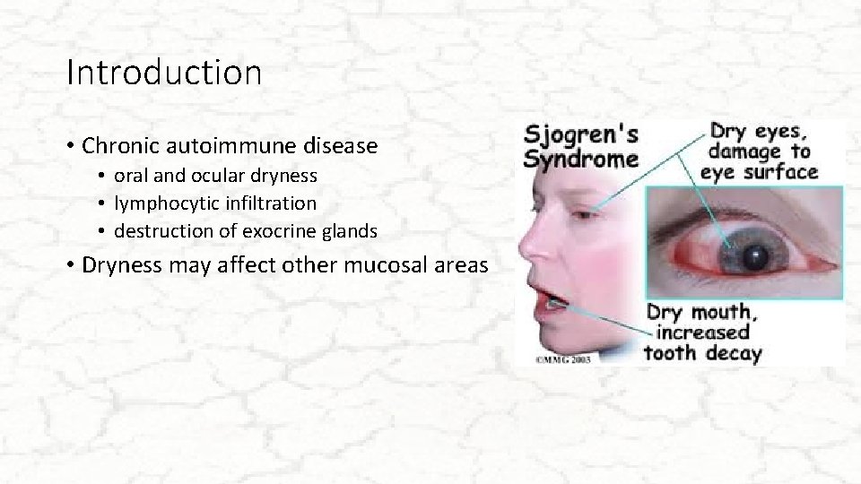 Introduction • Chronic autoimmune disease • oral and ocular dryness • lymphocytic infiltration •