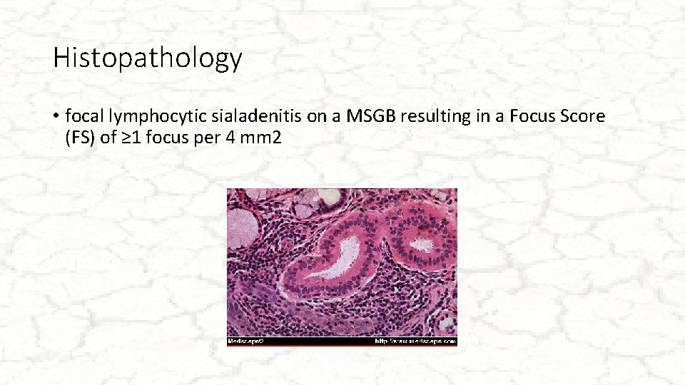 Histopathology • focal lymphocytic sialadenitis on a MSGB resulting in a Focus Score (FS)