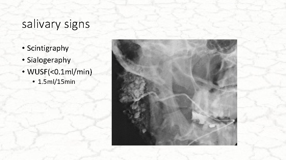 salivary signs • Scintigraphy • Sialogeraphy • WUSF(<0. 1 ml/min) • 1. 5 ml/15