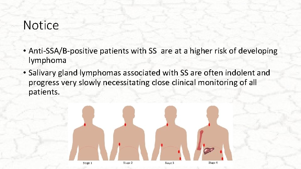 Notice • Anti-SSA/B-positive patients with SS are at a higher risk of developing lymphoma