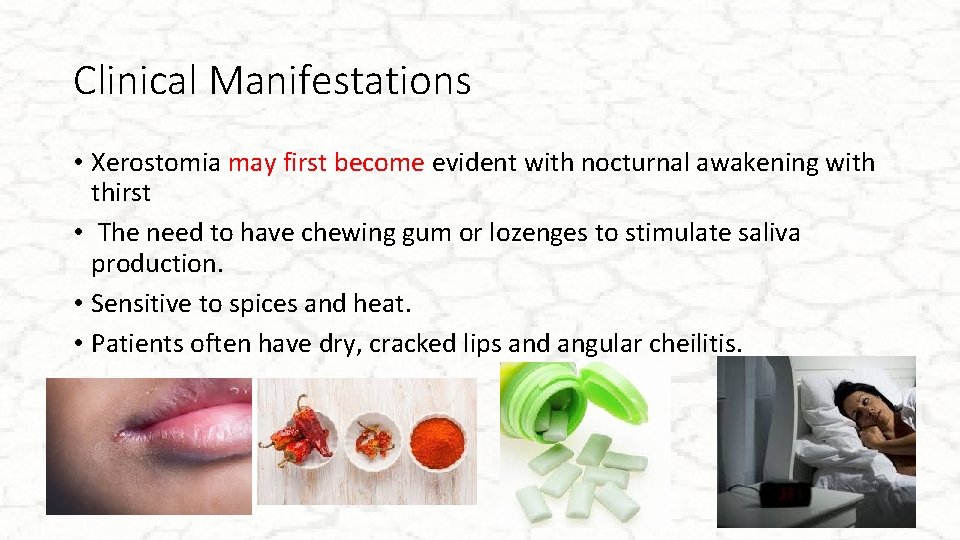 Clinical Manifestations • Xerostomia may first become evident with nocturnal awakening with thirst •