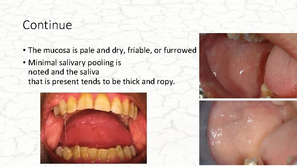 Continue • The mucosa is pale and dry, friable, or furrowed • Minimal salivary