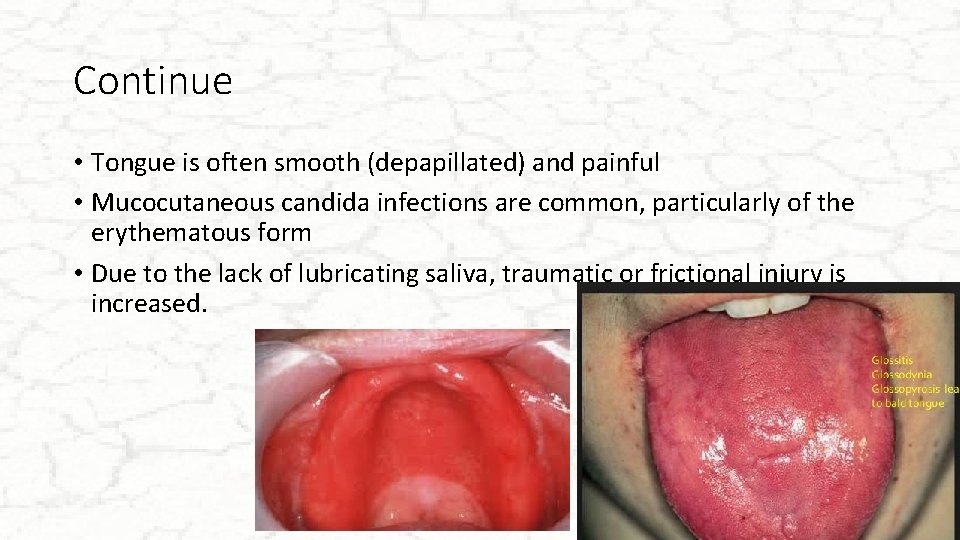 Continue • Tongue is often smooth (depapillated) and painful • Mucocutaneous candida infections are