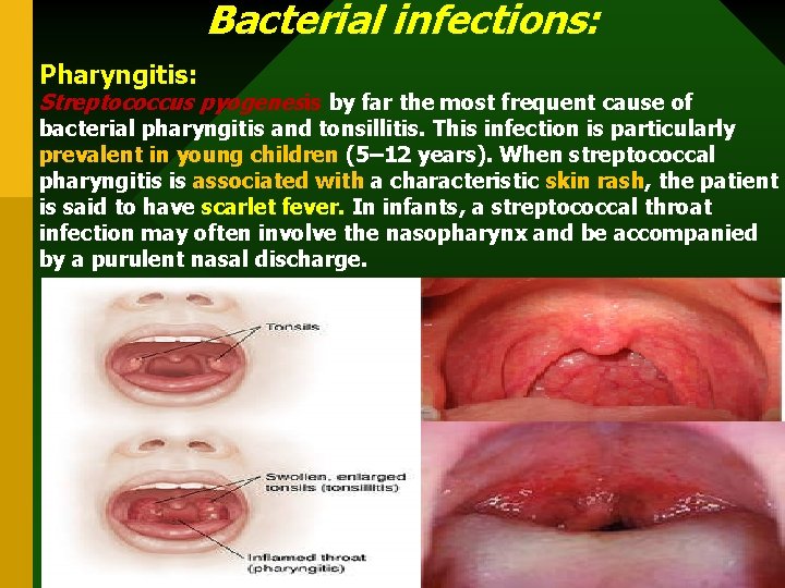 Bacterial infections: Pharyngitis: Streptococcus pyogenesis by far the most frequent cause of bacterial pharyngitis