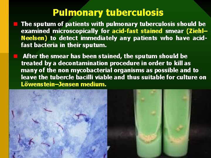 Pulmonary tuberculosis n The sputum of patients with pulmonary tuberculosis should be examined microscopically