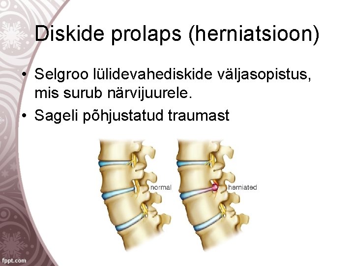 Diskide prolaps (herniatsioon) • Selgroo lülidevahediskide väljasopistus, mis surub närvijuurele. • Sageli põhjustatud traumast