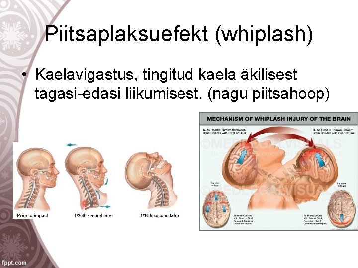 Piitsaplaksuefekt (whiplash) • Kaelavigastus, tingitud kaela äkilisest tagasi-edasi liikumisest. (nagu piitsahoop) 