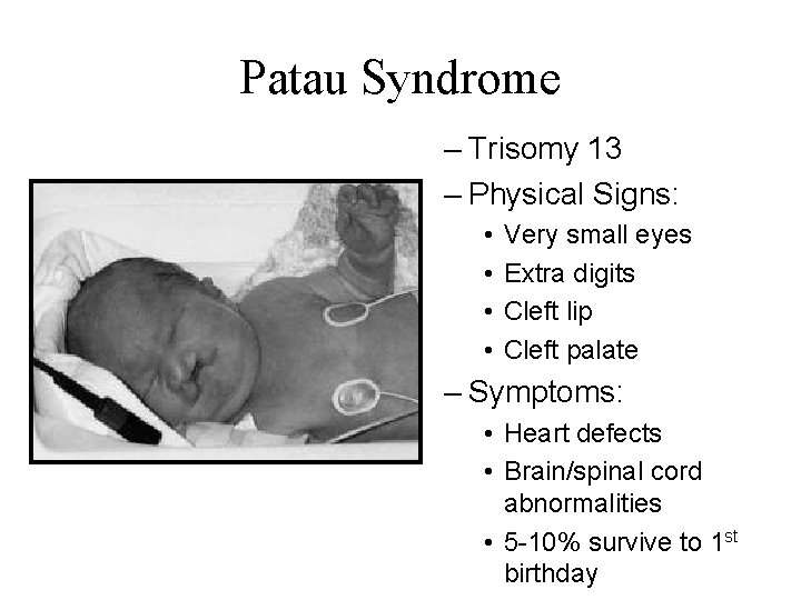 Patau Syndrome – Trisomy 13 – Physical Signs: • • Very small eyes Extra