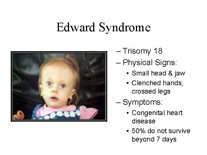 Edward Syndrome – Trisomy 18 – Physical Signs: • Small head & jaw •