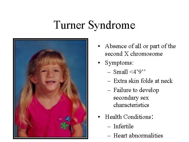 Turner Syndrome • Absence of all or part of the second X chromosome •