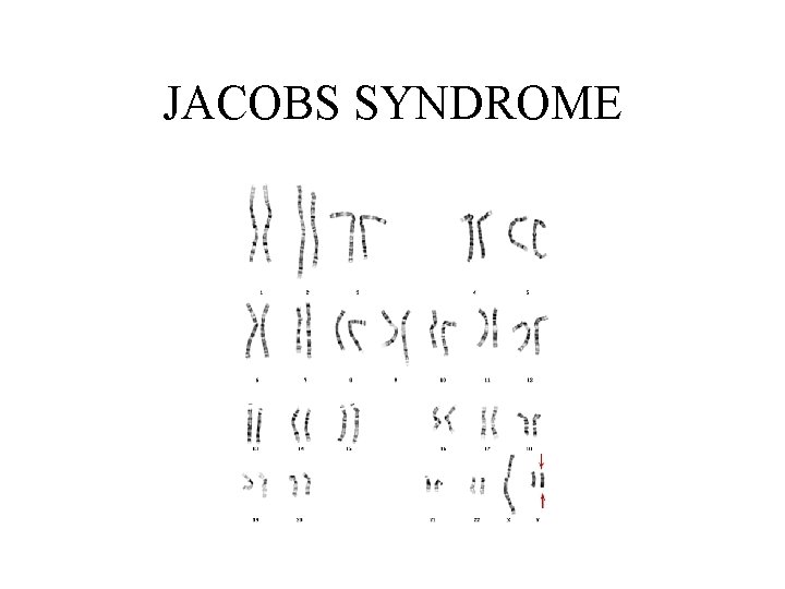 JACOBS SYNDROME 