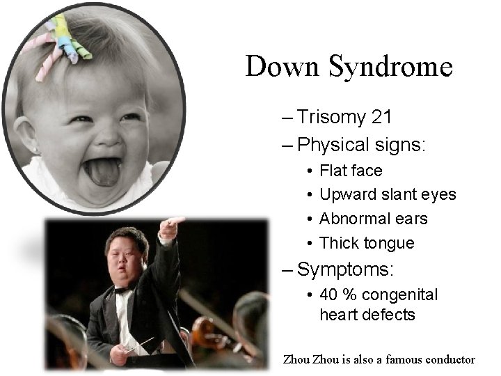Down Syndrome – Trisomy 21 – Physical signs: • • Flat face Upward slant