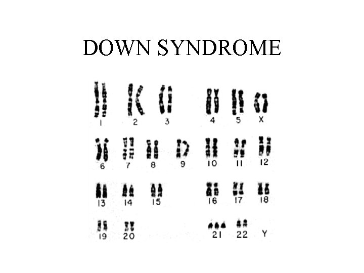 DOWN SYNDROME 