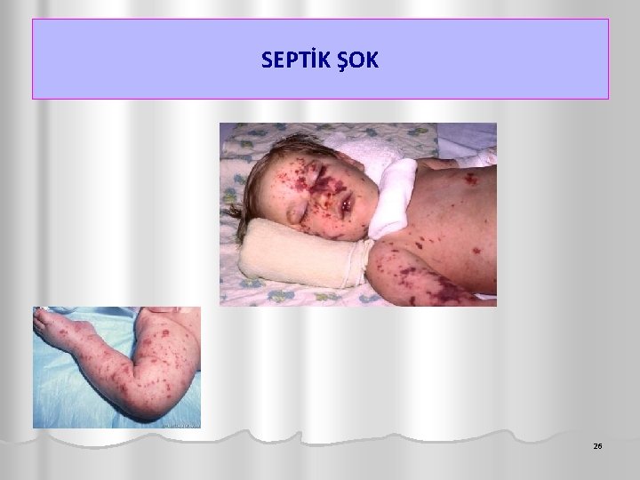 SEPTİK ŞOK 26 