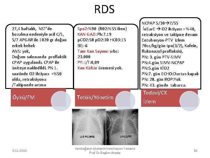 RDS 27, 4 haftalık, NST’de bozulma nedeniyle acil C/S, 5/7 APGAR ile 1020 gr