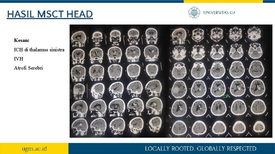 HASIL MSCT HEAD Kesan: ICH di thalamus sinistra IVH Atrofi Serebri 