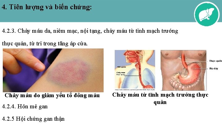 4. Tiên lượng và biến chứng: 4. 2. 3. Chảy máu da, niêm mạc,