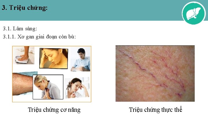 3. Triệu chứng: 3. 1. Lâm sàng: 3. 1. 1. Xơ gan giai đoạn