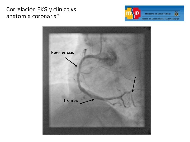 Correlación EKG y clínica vs anatomía coronaria? Reestenosis Trombo 