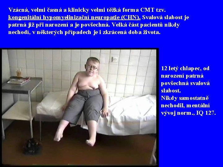 Vzácná, velmi časná a klinicky velmi těžká forma CMT tzv. kongenitální hypomyelinizační neuropatie (CHN).