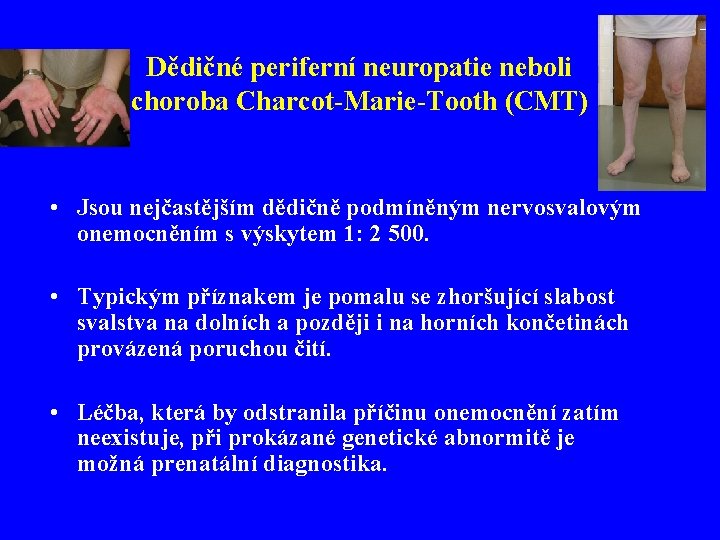 Dědičné periferní neuropatie neboli choroba Charcot-Marie-Tooth (CMT) • Jsou nejčastějším dědičně podmíněným nervosvalovým onemocněním