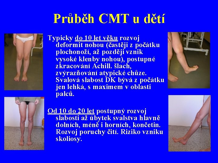 Průběh CMT u dětí Typicky do 10 let věku rozvoj deformit nohou (častěji z