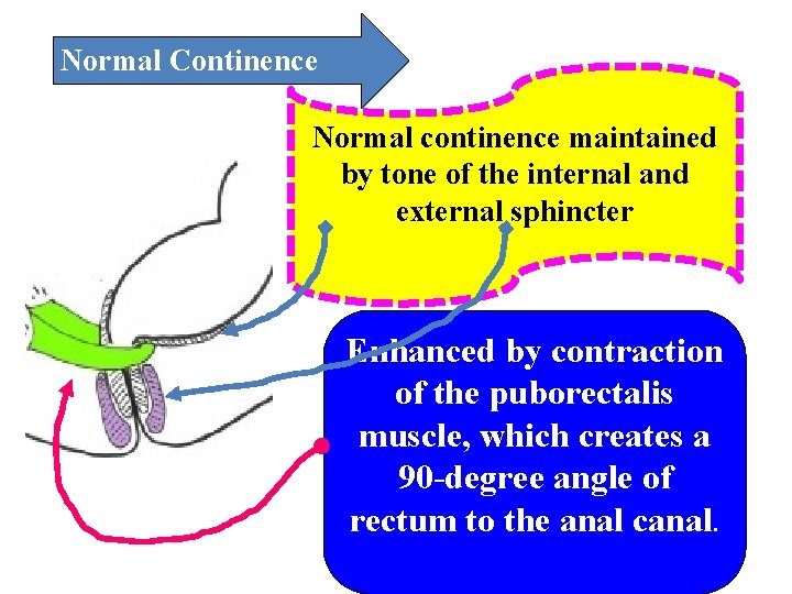 Normal Continence Normal continence maintained by tone of the internal and external sphincter Enhanced