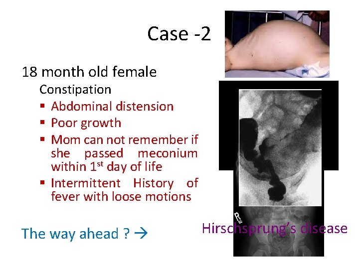 Case -2 18 month old female Constipation § Abdominal distension § Poor growth §