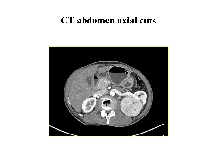 CT abdomen axial cuts 