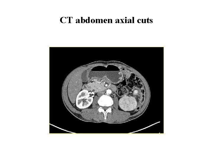 CT abdomen axial cuts 