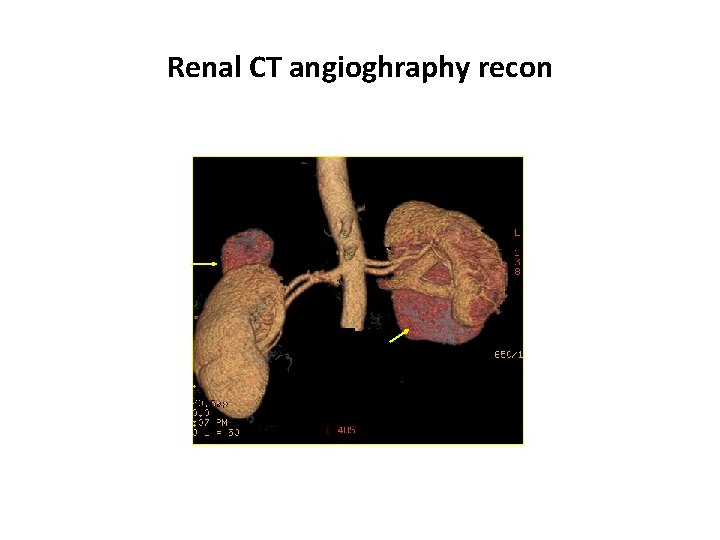 Renal CT angioghraphy recon 