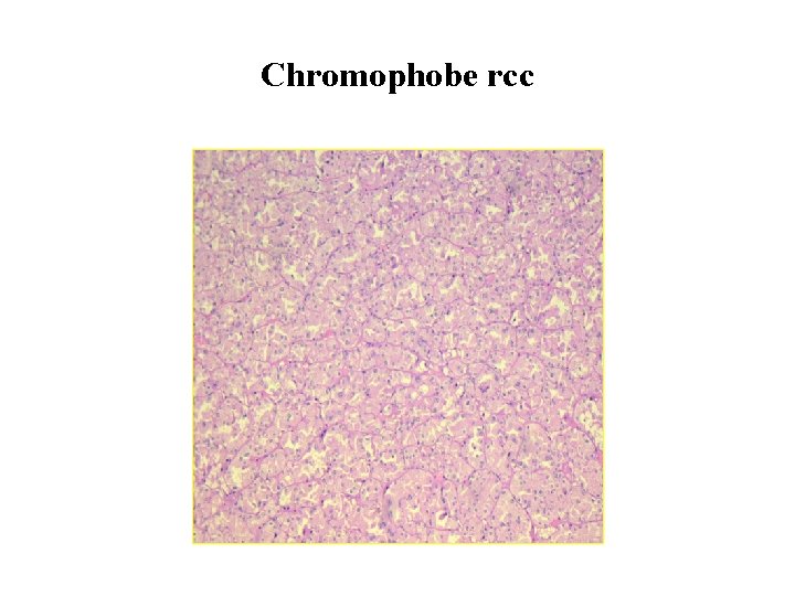 Chromophobe rcc 