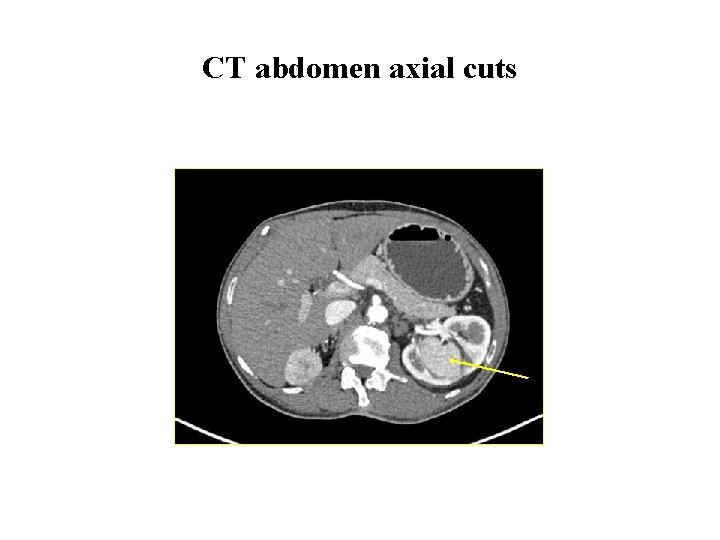 CT abdomen axial cuts 