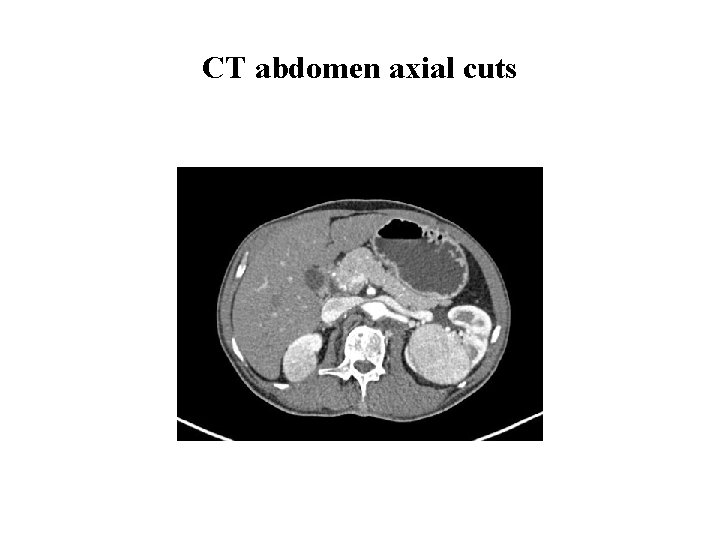 CT abdomen axial cuts 