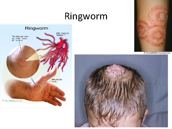 Ringworm 