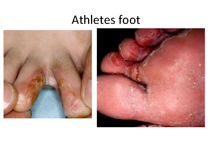 Athletes foot 