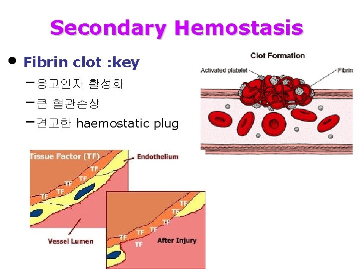 Secondary Hemostasis • Fibrin clot : key –응고인자 활성화 –큰 혈관손상 –견고한 haemostatic plug