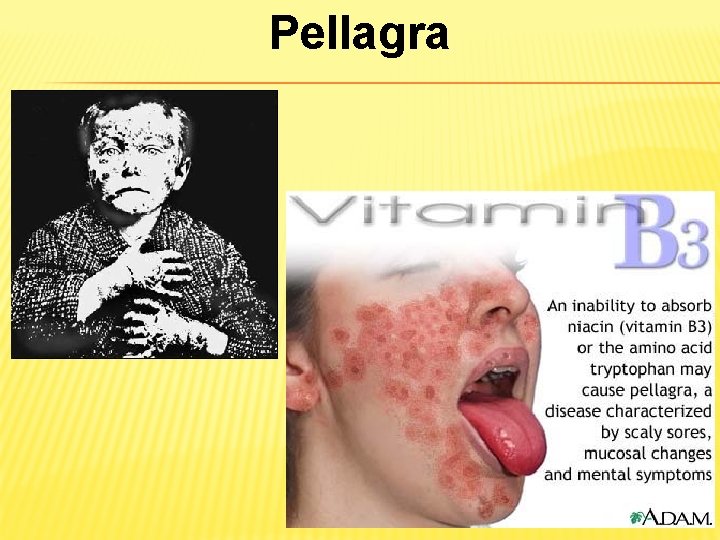 Pellagra 