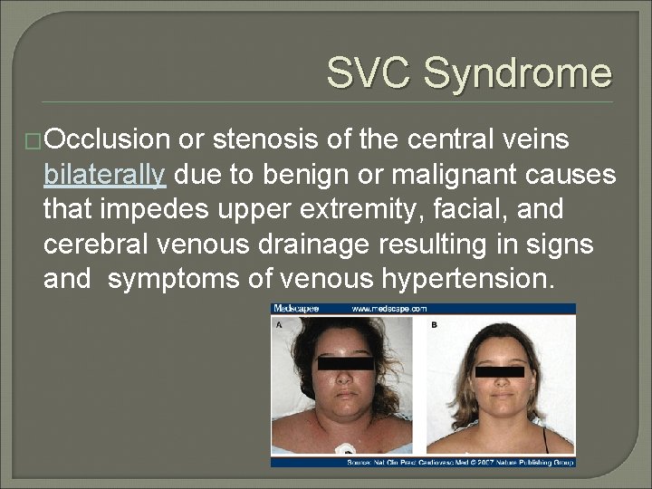 SVC Syndrome �Occlusion or stenosis of the central veins bilaterally due to benign or
