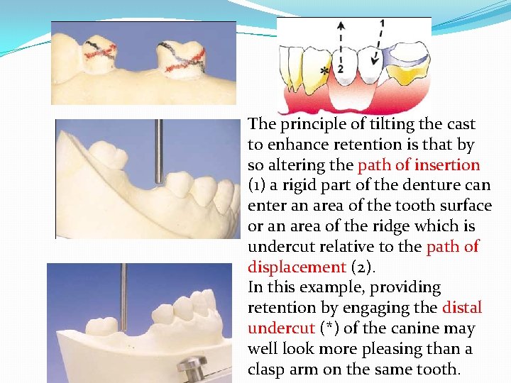 The principle of tilting the cast to enhance retention is that by so altering