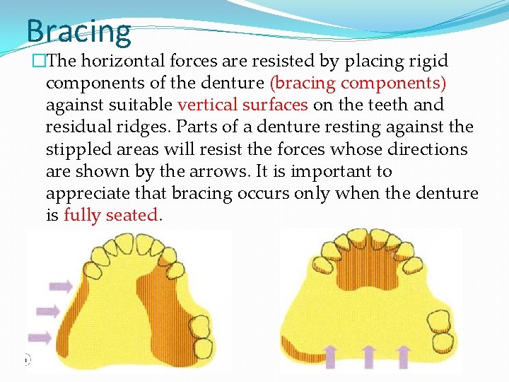 Bracing �The horizontal forces are resisted by placing rigid components of the denture (bracing