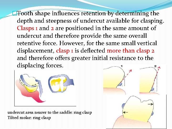�Tooth shape influences retention by determining the depth and steepness of undercut available for