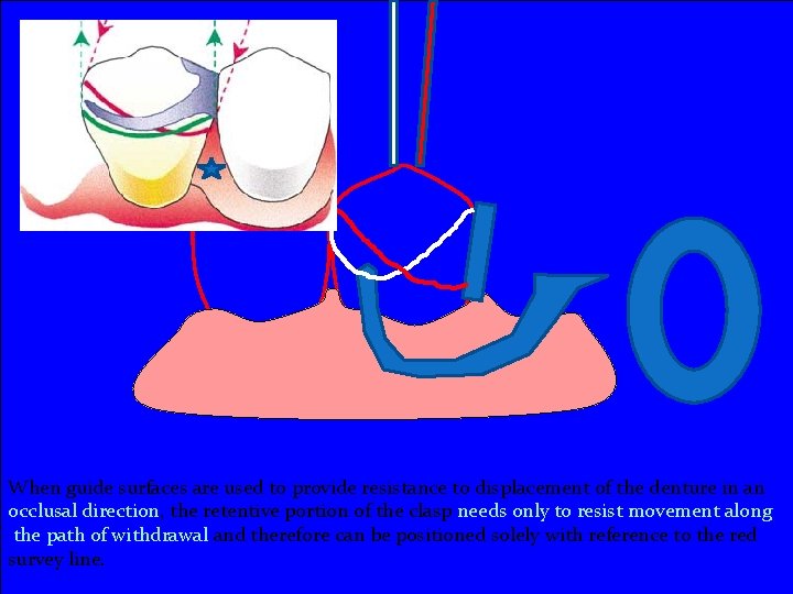 When guide surfaces are used to provide resistance to displacement of the denture in