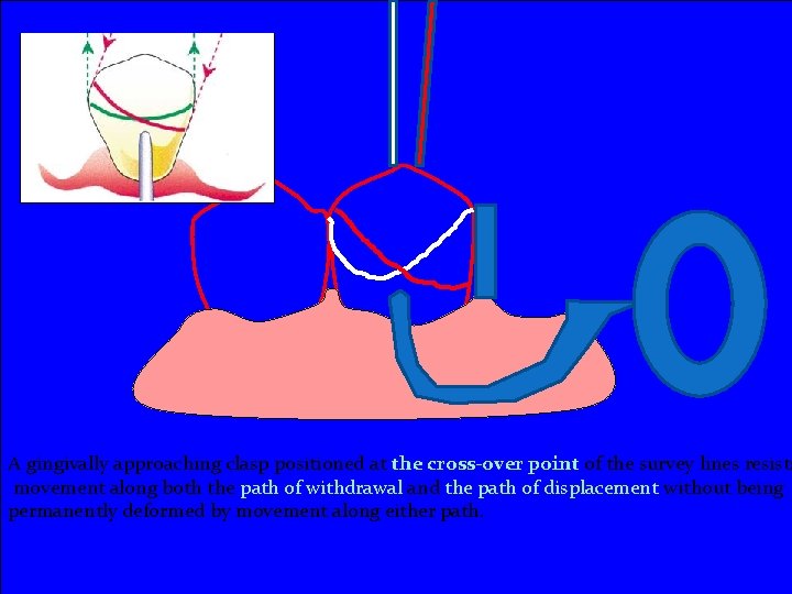 A gingivally approaching clasp positioned at the cross-over point of the survey lines resists