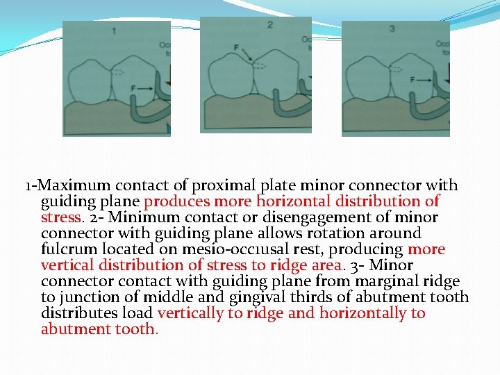 1 -Maximum contact of proximal plate minor connector with guiding plane produces more horizontal